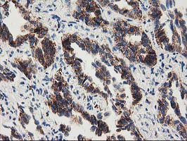 MMAB Antibody - IHC of paraffin-embedded Carcinoma of Human lung tissue using anti-MMAB mouse monoclonal antibody. (Heat-induced epitope retrieval by 10mM citric buffer, pH6.0, 100C for 10min).
