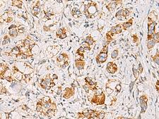 MMAB Antibody - Immunohistochemistry of paraffin-embedded Human liver cancer tissue  using MMAB Polyclonal Antibody at dilution of 1:65(×200)