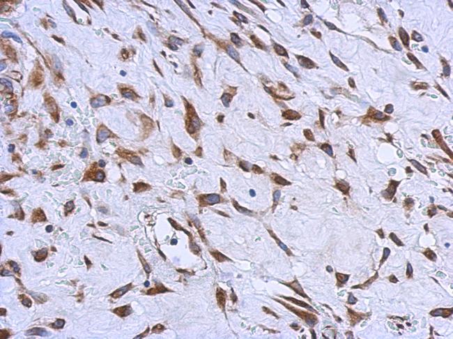 MMACHC Antibody - IHC of paraffin-embedded Hepatoma using MMACHC antibody at 1:500 dilution.