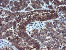 MMACHC Antibody - IHC of paraffin-embedded Adenocarcinoma of Human ovary tissue using anti-MMACHC mouse monoclonal antibody. (Heat-induced epitope retrieval by 10mM citric buffer, pH6.0, 100C for 10min).