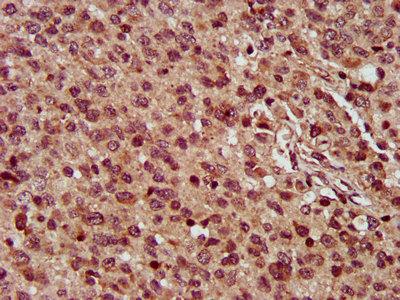 MMADHC / C2orf25 Antibody - Immunohistochemistry image at a dilution of 1:300 and staining in paraffin-embedded human glioma cancer performed on a Leica BondTM system. After dewaxing and hydration, antigen retrieval was mediated by high pressure in a citrate buffer (pH 6.0) . Section was blocked with 10% normal goat serum 30min at RT. Then primary antibody (1% BSA) was incubated at 4 °C overnight. The primary is detected by a biotinylated secondary antibody and visualized using an HRP conjugated SP system.