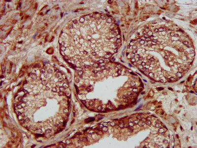 MMADHC / C2orf25 Antibody - Immunohistochemistry image at a dilution of 1:300 and staining in paraffin-embedded human prostate cancer performed on a Leica BondTM system. After dewaxing and hydration, antigen retrieval was mediated by high pressure in a citrate buffer (pH 6.0) . Section was blocked with 10% normal goat serum 30min at RT. Then primary antibody (1% BSA) was incubated at 4 °C overnight. The primary is detected by a biotinylated secondary antibody and visualized using an HRP conjugated SP system.