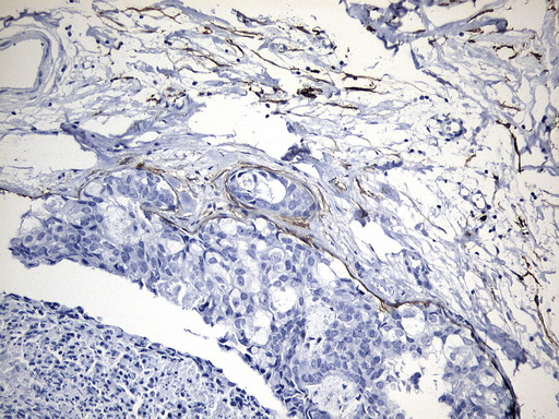 MME / CD10 Antibody - Immunohistochemical staining of paraffin-embedded Adenocarcinoma of Human breast tissue tissue using anti-MME. (CD10) mouse monoclonal antibody. (Heat-induced epitope retrieval by 1mM EDTA in 10mM Tris buffer. (pH9.0) at 120°C for 3 min. (1:600)