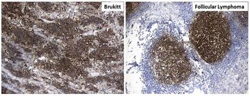 MME / CD10 Antibody - Immunohistochemical staining of paraffin-embedded Human lymphoma tissue(On the left is brukitt, on the right is follicular lymphoma) using anti-MME. (CD10) Mouse monoclonal antibody. (Heat-induced epitope retrieval by 1mM EDTA in 10mM Tris buffer. (pH9.0) at 120°C for 3 min. (1:600)