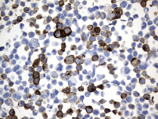 MME / CD10 Antibody - Immunohistochemical staining of paraffin-embedded MDA-MB-453 cell pellets using anti-MME. (CD10) mouse monoclonal antibody. (Heat-induced epitope retrieval by 1mM EDTA in 10mM Tris buffer. (pH9.0) at 120°C for 2.5 min. (1:600)