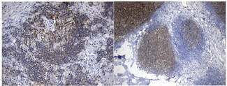 MME / CD10 Antibody - Immunohistochemical staining of paraffin-embedded Human lymphoma tissue(On the left is brukitt, on the right is follicular lymphoma) using anti-MME. (CD10) Mouse monoclonal antibody. (Heat-induced epitope retrieval by 1mM EDTA in 10mM Tris buffer. (pH9.0) at 120°C for 3 min. (1:600)