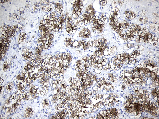 MME / CD10 Antibody - Immunohistochemical staining of paraffin-embedded Carcinoma of Human kidney tissue using anti-MME. (CD10) mouse monoclonal antibody. (Heat-induced epitope retrieval by 1mM EDTA in 10mM Tris buffer. (pH9.0) at 120°C for 3 min. (1:600)