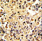 MME / CD10 Antibody - Formalin-fixed and paraffin-embedded human kidney carcinoma with Neprilysin Antibody , which was peroxidase-conjugated to the secondary antibody, followed by DAB staining. This data demonstrates the use of this antibody for immunohistochemistry; clinical relevance has not been evaluated.