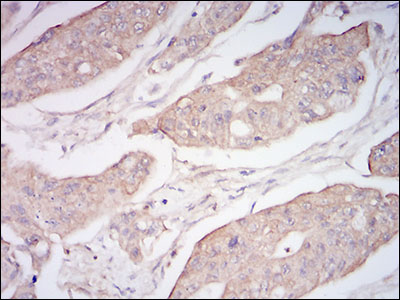 MME / CD10 Antibody - IHC of paraffin-embedded rectum cancer tissues using CD10 mouse monoclonal antibody with DAB staining.