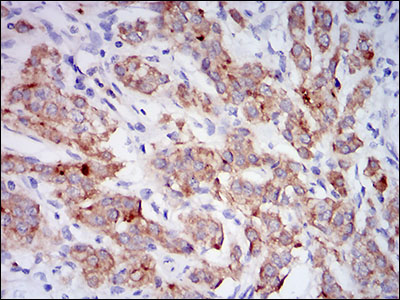 MME / CD10 Antibody - IHC of paraffin-embedded prostate cancer tissues using CD10 mouse monoclonal antibody with DAB staining.
