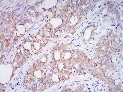 MME / CD10 Antibody - IHC of paraffin-embedded cervical cancer tissues using CD10 mouse monoclonal antibody with DAB staining.