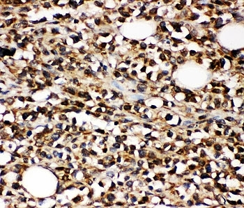 MME / CD10 Antibody - IHC-P: CD10 antibody testing of human B-lymphocyte cancer tissue
