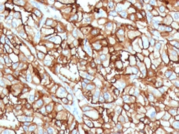 MME / CD10 Antibody - IHC staining of FFPE human renal cell carcinoma with CD10 antibody (clone CDLA10-1). Required HEIR: boil tissue sections in 10mM Tris with 1mM EDTA, pH 9, for 10-20 min and allow to cool before testing.