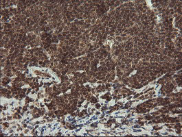MME / CD10 Antibody - IHC of paraffin-embedded Human lymphoma tissue using anti-MME mouse monoclonal antibody. (Heat-induced epitope retrieval by 10mM citric buffer, pH6.0, 100C for 10min).