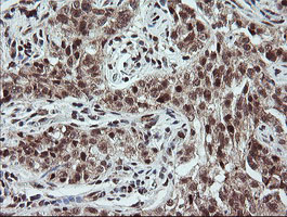 MME / CD10 Antibody - IHC of paraffin-embedded Carcinoma of Human kidney tissue using anti-MME mouse monoclonal antibody. (Heat-induced epitope retrieval by 10mM citric buffer, pH6.0, 100C for 10min).