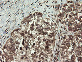 MME / CD10 Antibody - IHC of paraffin-embedded Adenocarcinoma of Human ovary tissue using anti-MME mouse monoclonal antibody. (Heat-induced epitope retrieval by 10mM citric buffer, pH6.0, 100C for 10min).