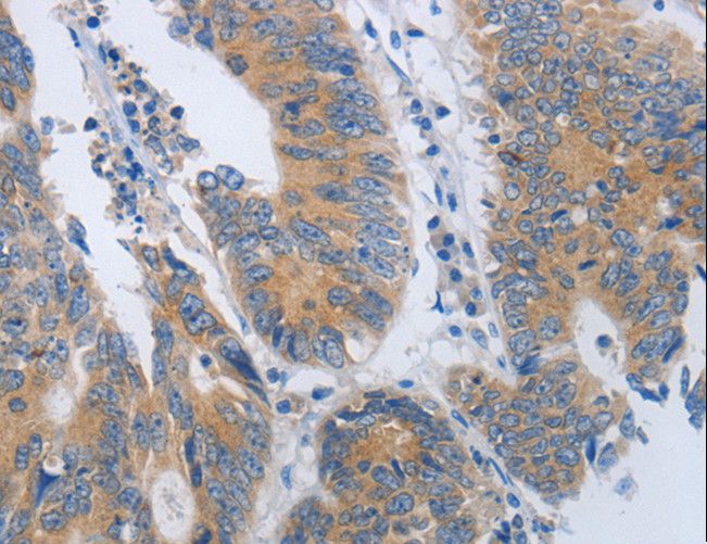 MME / CD10 Antibody - Immunohistochemistry of paraffin-embedded Human colon cancer using MME Polyclonal Antibody at dilution of 1:45.