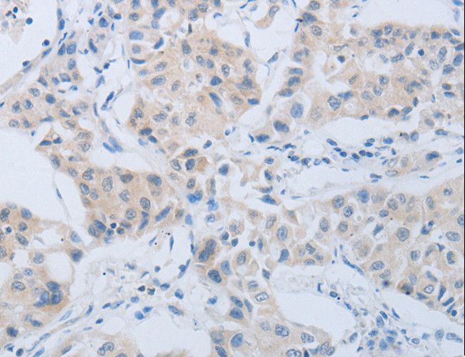 MME / CD10 Antibody - Immunohistochemistry of paraffin-embedded Human lung cancer using MME Polyclonal Antibody at dilution of 1:45.