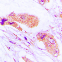 MMP1 Antibody - Immunohistochemical analysis of MMP1 staining in human lung cancer formalin fixed paraffin embedded tissue section. The section was pre-treated using heat mediated antigen retrieval with sodium citrate buffer (pH 6.0). The section was then incubated with the antibody at room temperature and detected using an HRP conjugated compact polymer system. DAB was used as the chromogen. The section was then counterstained with hematoxylin and mounted with DPX.