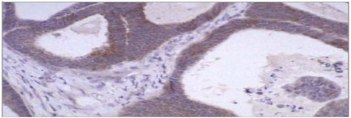 MMP1 Antibody - A. Immunohistochemical staining using MMP-1 antibody (Matrix Metalloproteinase 1 (MMP1)) on colon carcinoma tissue section. B. Western blot of MMP-1 antibody on recombinant human MMP-1 proenzyme (400 ng/lane).
