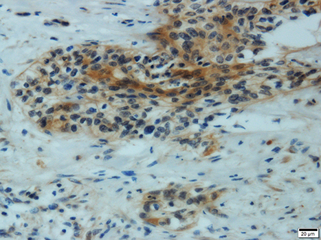MMP1 Antibody - Immunohistochemistry of paraffin-embedded human cervical carcinoma using MMP1 antibodyat dilution of 1:300 (40x lens).