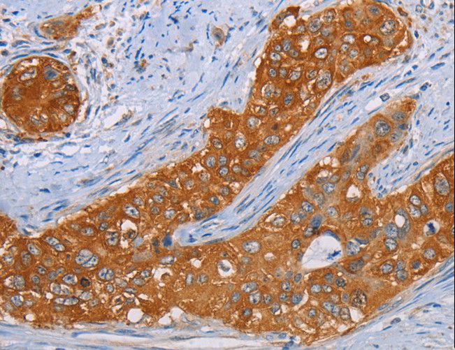 MMP1 Antibody - Immunohistochemistry of paraffin-embedded Human cervical cancer using MMP1 Polyclonal Antibody at dilution of 1:55.