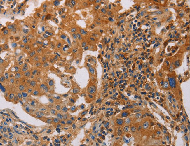 MMP1 Antibody - Immunohistochemistry of paraffin-embedded Human cervical cancer using MMP1 Polyclonal Antibody at dilution of 1:55.