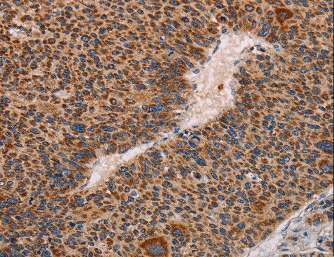 MMP1 Antibody - Immunohistochemistry of paraffin-embedded Human liver cancer using MMP1 Polyclonal Antibody at dilution of 1:60.
