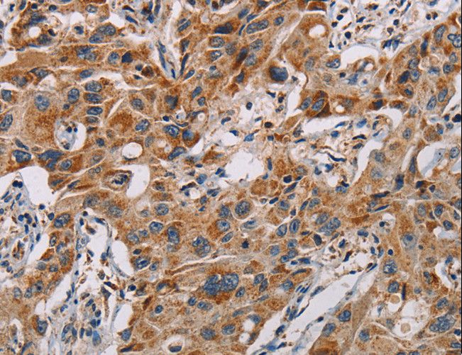 MMP1 Antibody - Immunohistochemistry of paraffin-embedded Human lung cancer using MMP1 Polyclonal Antibody at dilution of 1:60.