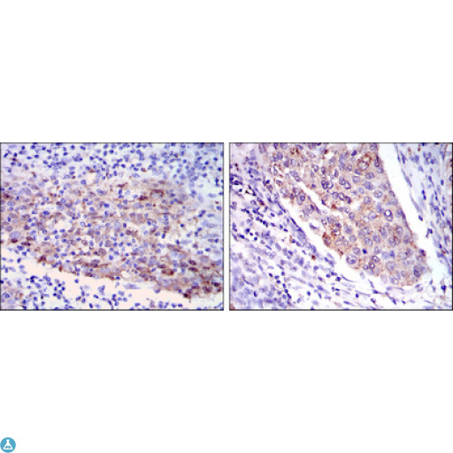 MMP1 Antibody - Immunohistochemistry (IHC) analysis of paraffin-embedded human cervical cancer tissues (left) and Human Kidney cancer tissues (right) with DAB staining using MMP-1 Monoclonal Antibody.