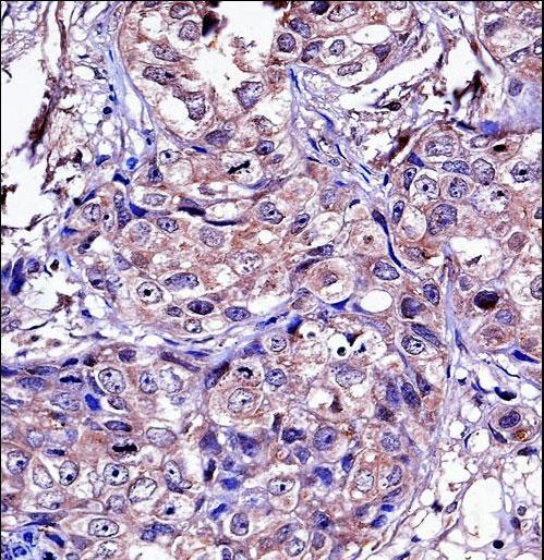 MMP11 Antibody - MMP11 Antibody immunohistochemistry of formalin-fixed and paraffin-embedded human breast carcinoma followed by peroxidase-conjugated secondary antibody and DAB staining.