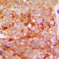 MMP11 Antibody - Immunohistochemical analysis of MMP11 staining in human breast cancer formalin fixed paraffin embedded tissue section. The section was pre-treated using heat mediated antigen retrieval with sodium citrate buffer (pH 6.0). The section was then incubated with the antibody at room temperature and detected using an HRP conjugated compact polymer system. DAB was used as the chromogen. The section was then counterstained with hematoxylin and mounted with DPX.