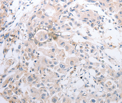 MMP11 Antibody - Immunohistochemistry of paraffin-embedded human lung cancer tissue.