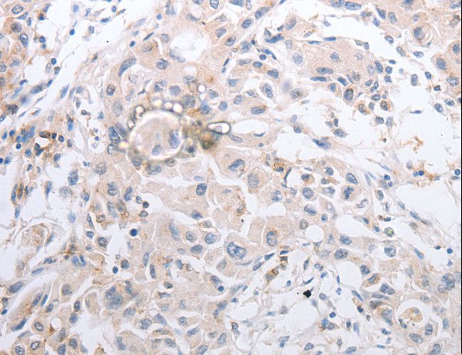 MMP11 Antibody - Immunohistochemistry of paraffin-embedded Human lung cancer using MMP11 Polyclonal Antibody at dilution of 1:40.