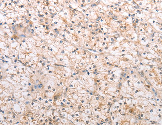 MMP11 Antibody - Immunohistochemistry of paraffin-embedded Human renal cancer using MMP11 Polyclonal Antibody at dilution of 1:40.
