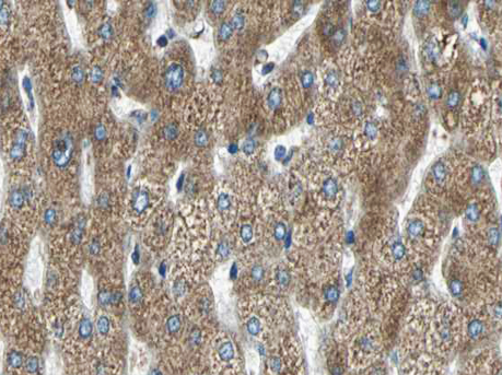 MMP11 Antibody - 1:100 staining human liver carcinoma tissues by IHC-P. The tissue was formaldehyde fixed and a heat mediated antigen retrieval step in citrate buffer was performed. The tissue was then blocked and incubated with the antibody for 1.5 hours at 22 °C. An HRP conjugated goat anti-rabbit antibody was used as the secondary.
