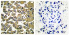 MMP11 Antibody - Peptide - + Immunohistochemical analysis of paraffin-embedded human breast carcinoma tissue using MMP-11 antibody.
