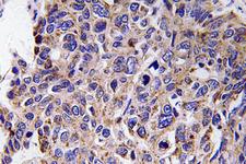 MMP12 Antibody - Immunohistochemistry analysis of MMP-12 antibody in paraffin-embedded human lung carcinoma tissue.