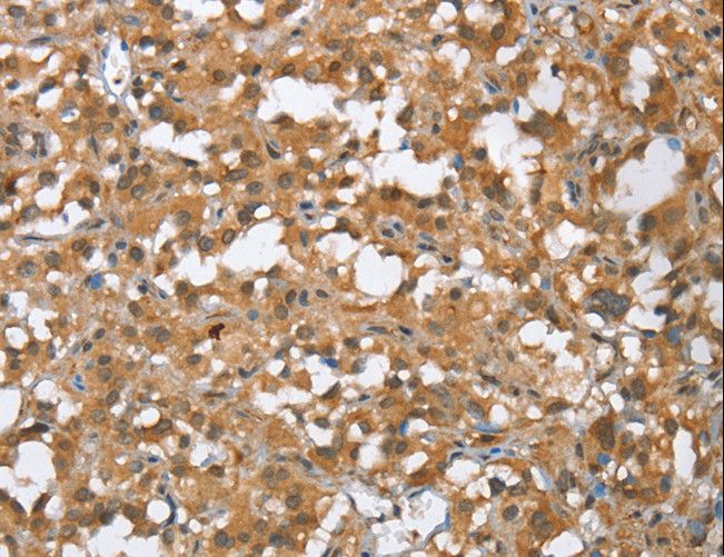 MMP12 Antibody - Immunohistochemistry of paraffin-embedded Human esophagus cancer using MMP12 Polyclonal Antibody at dilution of 1:60.