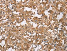 MMP12 Antibody - Immunohistochemistry of paraffin-embedded Human esophagus cancer using MMP12 Polyclonal Antibody at dilution of 1:60.