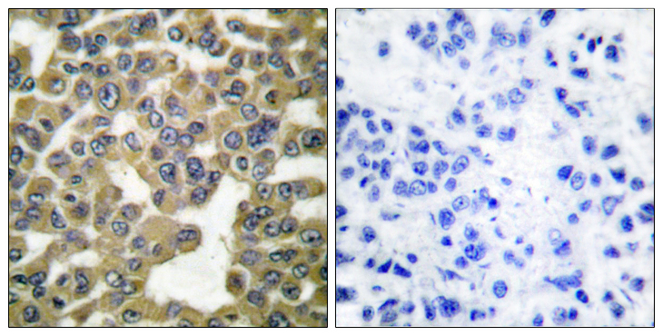 MMP13 Antibody - Immunohistochemistry analysis of paraffin-embedded human breast carcinoma tissue, using MMP-13 Antibody. The picture on the right is blocked with the synthesized peptide.