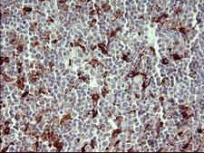 MMP13 Antibody - IHC of paraffin-embedded Human lymphoma tissue using anti-MMP13 mouse monoclonal antibody. (Heat-induced epitope retrieval by 10mM citric buffer, pH6.0, 120°C for 3min).