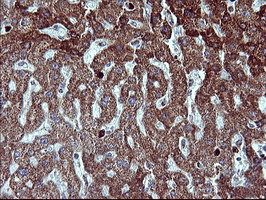 MMP13 Antibody - IHC of paraffin-embedded Human liver tissue using anti-MMP13 mouse monoclonal antibody. (Heat-induced epitope retrieval by 10mM citric buffer, pH6.0, 120°C for 3min).