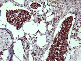 MMP13 Antibody - IHC of paraffin-embedded Carcinoma of Human bladder tissue using anti-MMP13 mouse monoclonal antibody. (Heat-induced epitope retrieval by 10mM citric buffer, pH6.0, 120°C for 3min).