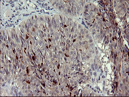MMP13 Antibody - IHC of paraffin-embedded Adenocarcinoma of Human ovary tissue using anti-MMP13 mouse monoclonal antibody. (Heat-induced epitope retrieval by 10mM citric buffer, pH6.0, 120°C for 3min).
