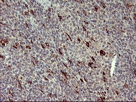 MMP13 Antibody - IHC of paraffin-embedded Human lymphoma tissue using anti-MMP13 mouse monoclonal antibody. (Heat-induced epitope retrieval by 10mM citric buffer, pH6.0, 120°C for 3min).
