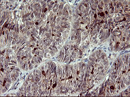 MMP13 Antibody - IHC of paraffin-embedded Adenocarcinoma of Human ovary tissue using anti-MMP13 mouse monoclonal antibody. (Heat-induced epitope retrieval by 10mM citric buffer, pH6.0, 120°C for 3min).
