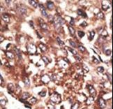 MMP13 Antibody - Formalin-fixed and paraffin-embedded human cancer tissue reacted with the primary antibody, which was peroxidase-conjugated to the secondary antibody, followed by AEC staining. This data demonstrates the use of this antibody for immunohistochemistry; clinical relevance has not been evaluated. BC = breast carcinoma; HC = hepatocarcinoma.