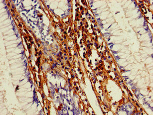 MMP13 Antibody - Immunohistochemistry of paraffin-embedded human colon cancer using MMP13 Antibody at dilution of 1:100