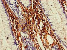 MMP13 Antibody - Immunohistochemistry of paraffin-embedded human colon cancer using MMP13 Antibody at dilution of 1:100